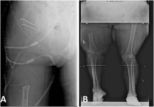 Pelvic radiograph and lower limb scanogram after hemipelvectomy with proximal femoral resection.