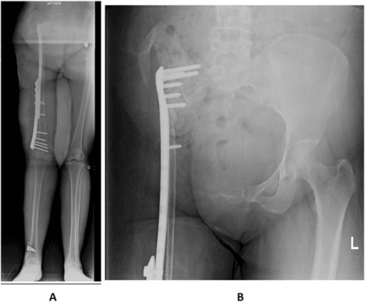Scanogram of both lower limbs alongside an anteroposterior pelvic radiograph at four months.