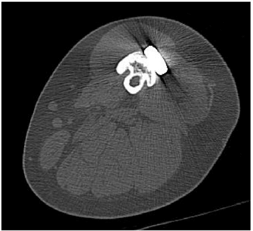 Axial CT showing a thickened inlaid fibular graft bridging to a frozen autograft.