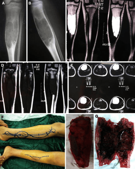 Multi-panel figure with tibial radiographs, MRI staging images and intraoperative resection and harvest planning.