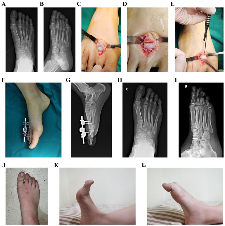 Preoperative radiographs, the surgical procedure, postoperative immobilisation and radiographs with restored activity at twenty-eight month follow-up