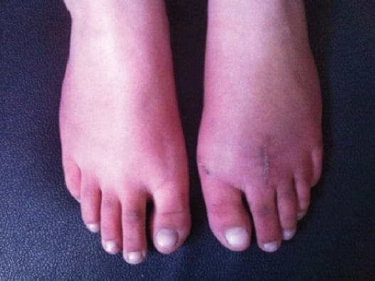 Clinical photograph of both feet showing mild shortening of the affected second toe