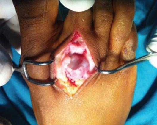 Intraoperative view of the damaged distal part of the metatarsal head exposed through a dorsal approach