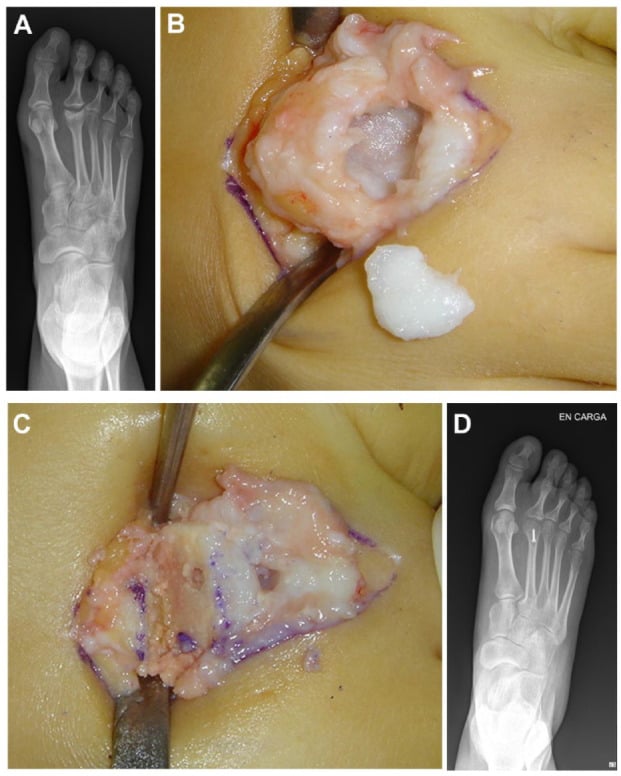 Radiograph showing collapse of the second metatarsal head with intraoperative excision of the osteochondral fragment and the corrected head after dorsiflexion osteotomy