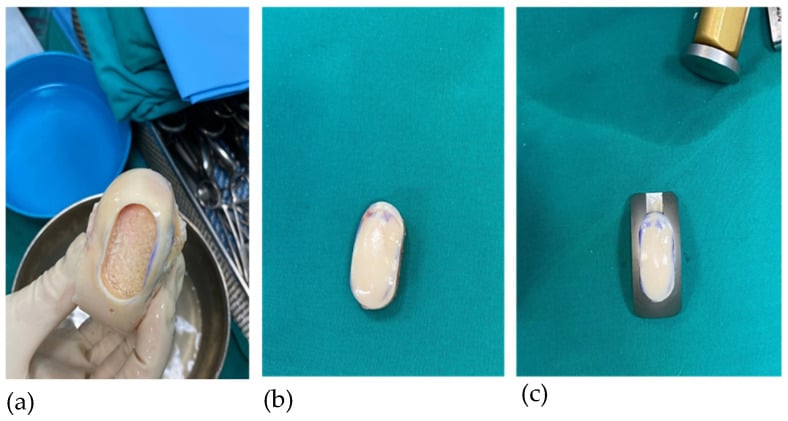 Osteochondral graft being cut to its final shape, the newly shaped graft, and the graft seated in a trial
