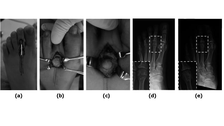 Intraoperative photographs through a longitudinal dorsal incision over the metatarsophalangeal joint showing severe cartilage deficiency, with postoperative radiographs