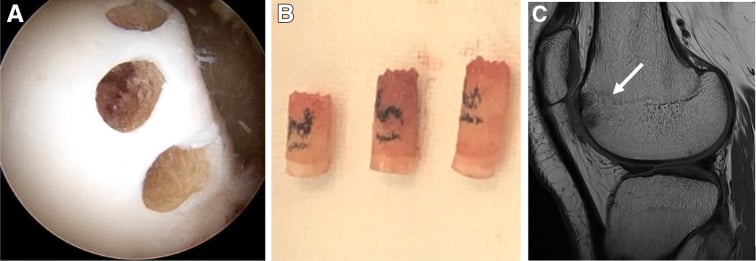 Arthroscopic harvest of three osteochondral autograft plugs from the lateral trochlea of the knee with the harvested plugs and donor site MRI