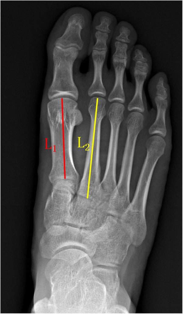 Weightbearing radiograph with first and second metatarsal lengths measured against each other