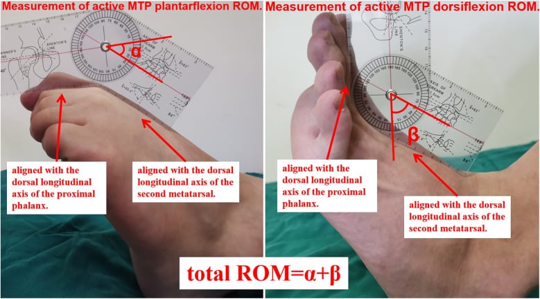 Goniometer measurement of active metatarsophalangeal joint plantarflexion and dorsiflexion with the fulcrum over the dorsal centre of the second MTP joint