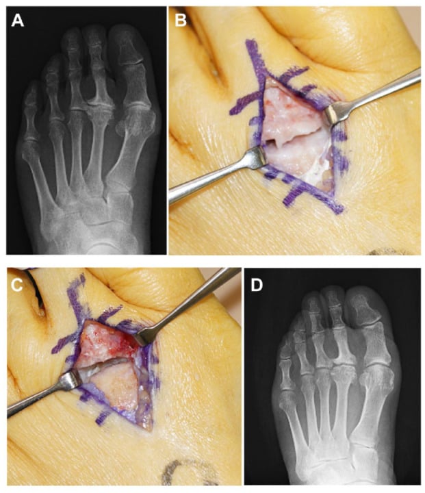Preoperative radiograph with joint space narrowing and osteophytes, intraoperative debridement of the second metatarsophalangeal joint and the postoperative film