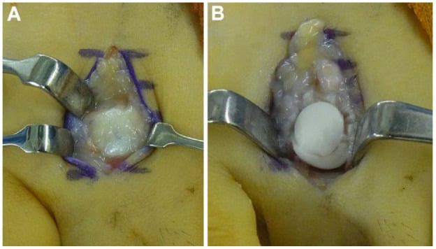 Intraoperative photographs showing collapse of the second metatarsal head articular surface then the cartilage surface reconstructed with an osteochondral plug