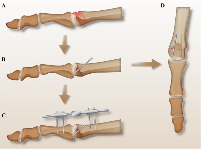 Surgical schematic showing the necrotic area and osteotomy line, the dorsal closing wedge being closed and the intact plantar joint surface rotated dorsally with fixation