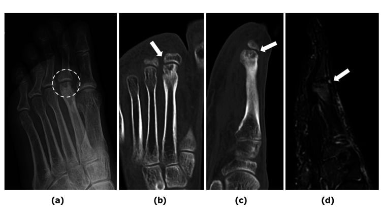 Medial oblique radiograph, axial CT and MRI of the second metatarsal head showing deformity and subchondral cysts