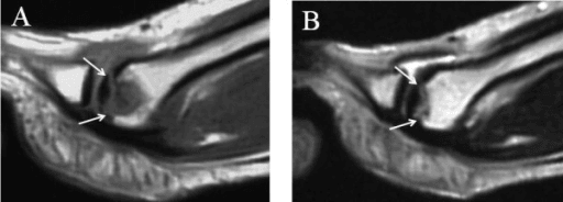 Sagittal MRI showing metatarsal head osteonecrosis