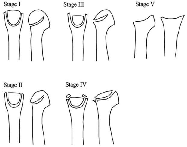Line drawings of Smillie stages I to V showing a fissure fracture, cancellous absorption with dorsal sinking, progressive collapse, loose body formation and end-stage arthritis