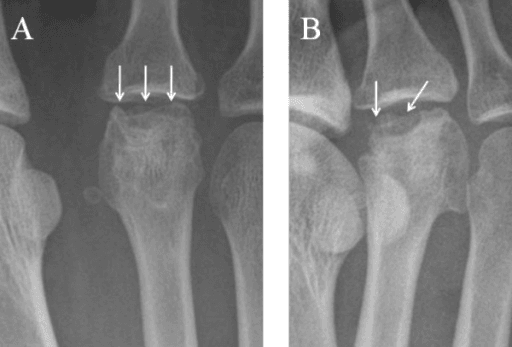 Radiographs showing Freiberg disease with metatarsal head flattening