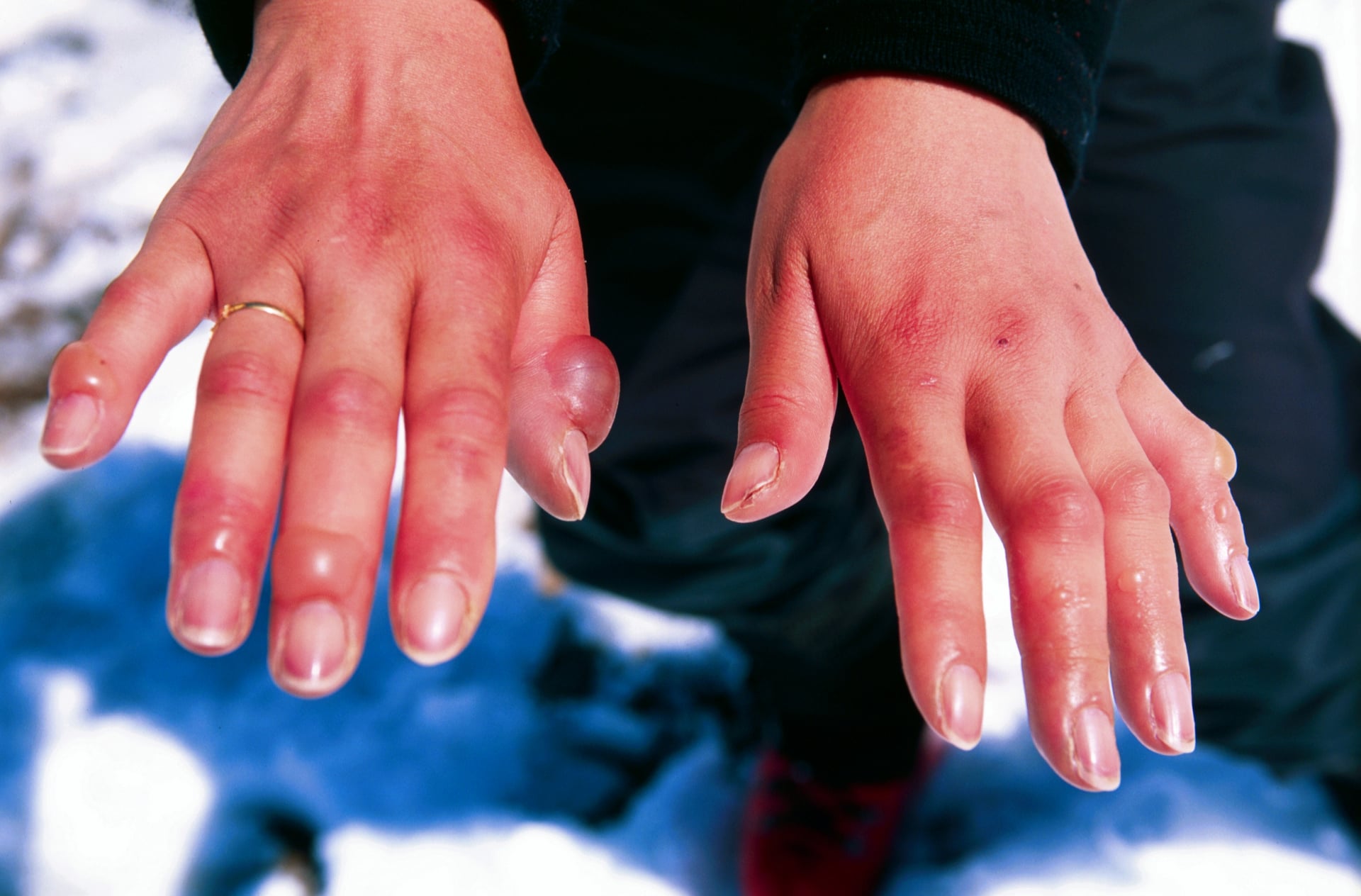 Both hands after frostbite showing red swollen fingers and tense fluid-filled blisters after rewarming.