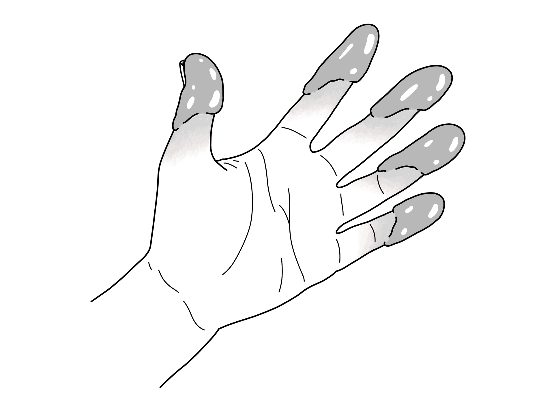 Illustration of a hand with clear blisters on all five fingertips representing superficial frostbite classification grade.