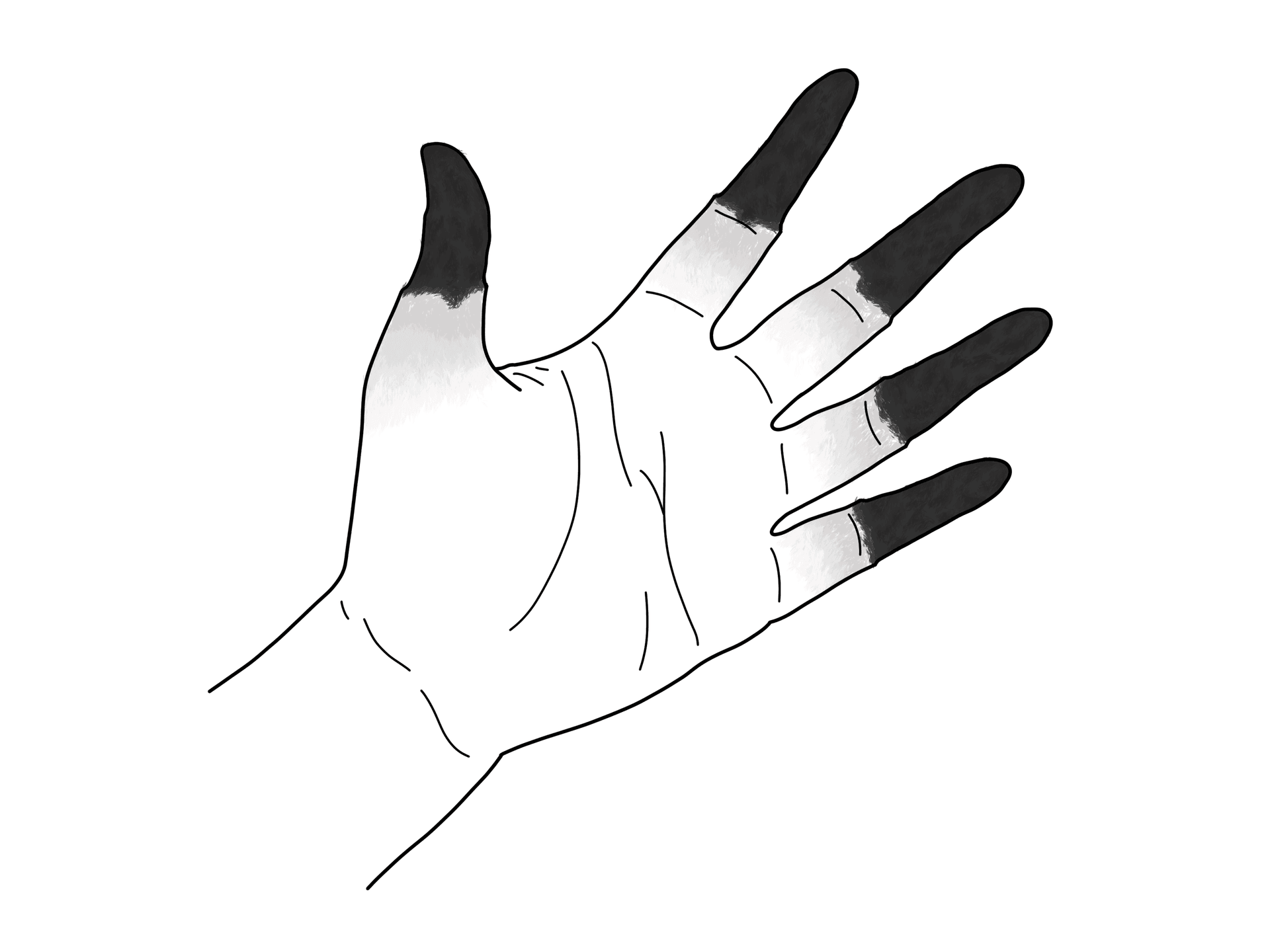 Illustration of a hand with blackened necrotic fingertips and a demarcation line representing deep full-thickness frostbite classification grade.
