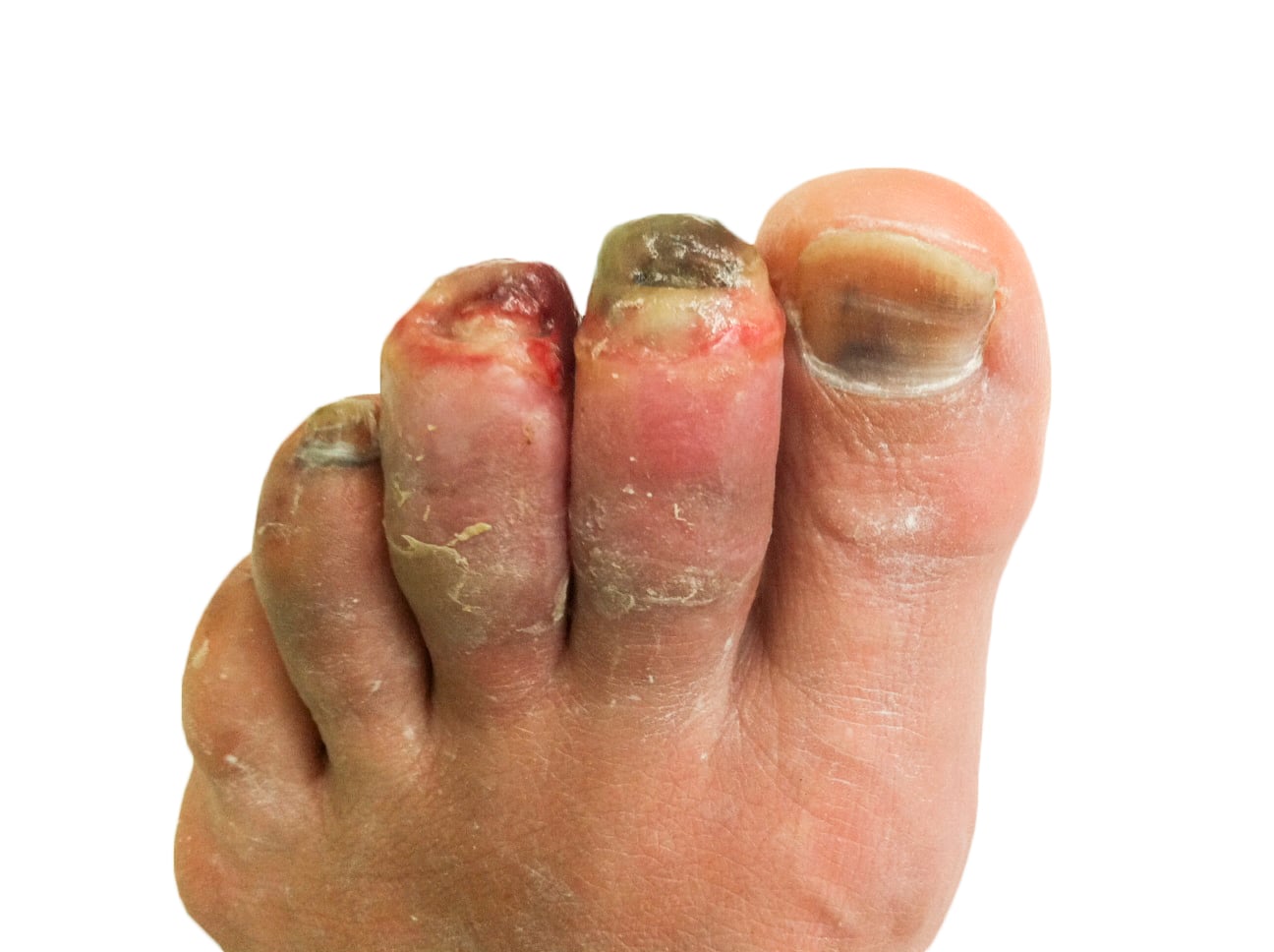 Toes three weeks after frostbite showing dark necrotic eschar of the great and second toe; clinical correlate of an absent-uptake bone scan.