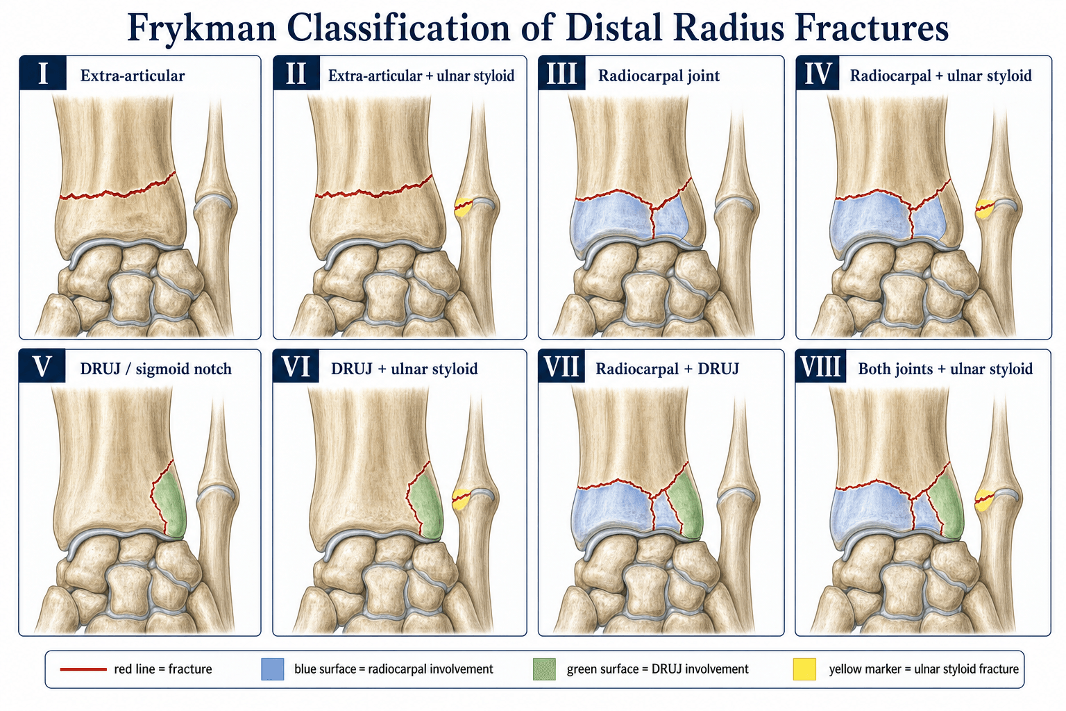 Frykman Classification of Distal Radius Fractures