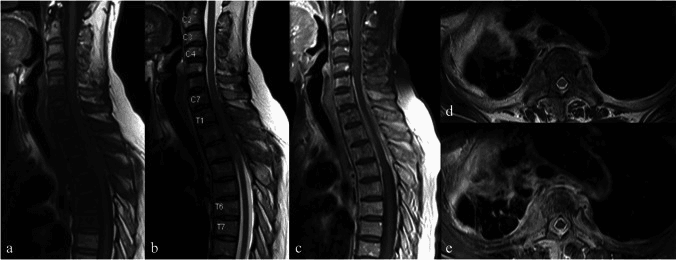 Sagittal (a to c) and axial (d, e) MRI of multilevel Aspergillus spondylitis of the cervicothoracic spine, with vertebral levels labelled C2 to T7 in panel b