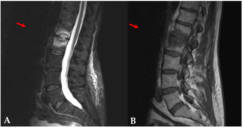 Two sagittal lumbar MRI sequences, panels A and B, of Aspergillus nidulans spondylodiscitis with the disc and adjacent endplates destroyed at one level