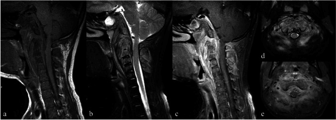 Sagittal (a to c) and axial (d, e) MRI of cervical actinomycosis spondylitis with abnormal signal in the cervical vertebrae and the soft tissue in front of them