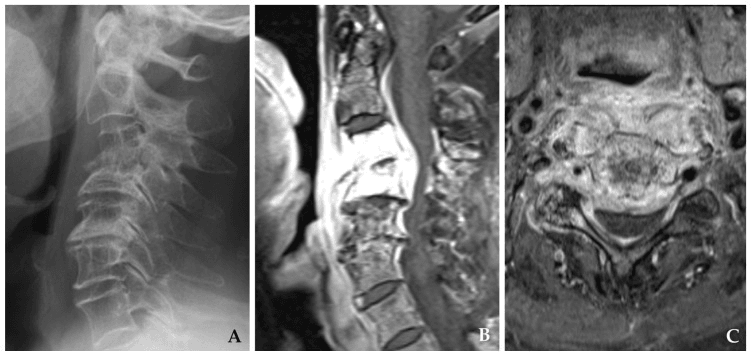 Lateral cervical radiograph with kyphosis (A) and sagittal (B) and axial (C) MRI of destructive cervical infection with soft-tissue extension