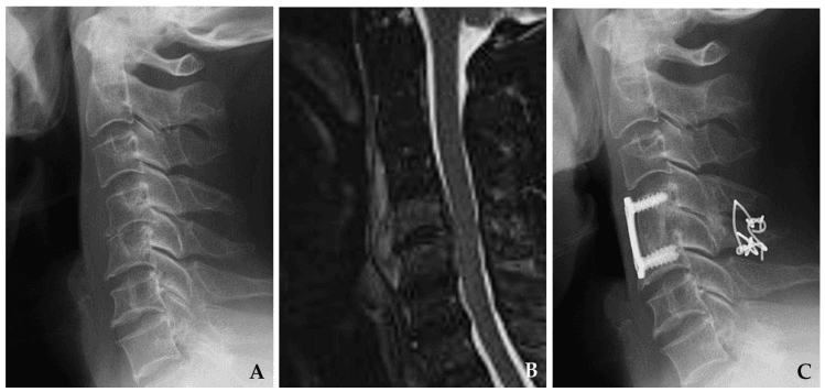 Cervical spondylodiscitis on a lateral radiograph (A) and sagittal MRI (B) before surgery, and a lateral radiograph (C) after anterior plate fixation with posterior wiring