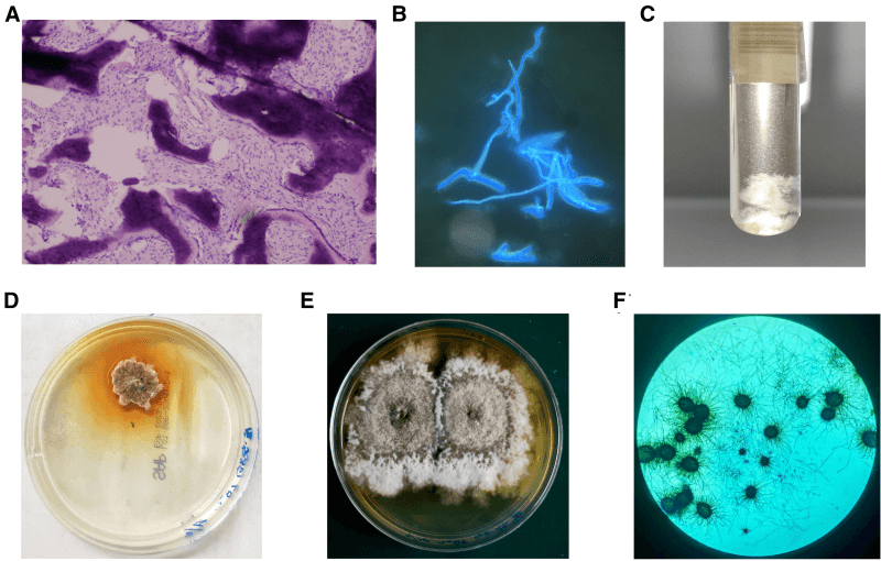 Six panels of Chaetomium vertebral osteomyelitis: bone histology, fluorescent staining of branching fungal filaments, growth in a culture tube, colonies on two culture plates, and microscopy of the cultured fungus