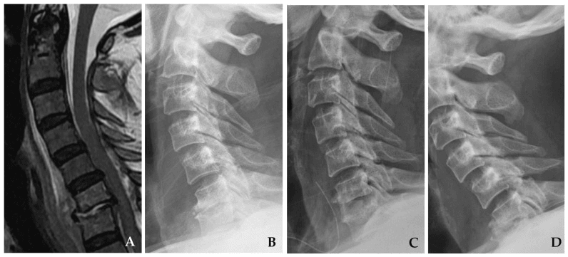 Sagittal cervical MRI (A) and serial lateral cervical radiographs (B to D) after surgery for cervical infection, with kyphosis developing across the series