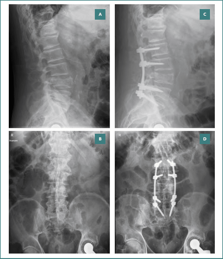 Lateral and AP lumbar radiographs before (A, B) and after (C, D) posterior instrumented fixation with pedicle screws and rods for spondylodiscitis