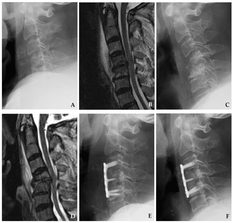 Serial lateral cervical radiographs and sagittal MRI showing progressive vertebral destruction and kyphosis, followed by lateral radiographs after anterior plate fixation