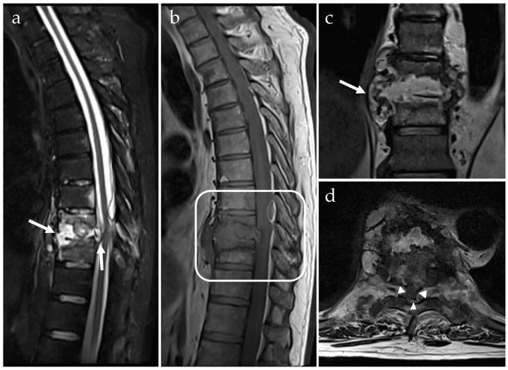 Sagittal, coronal and axial MRI of destructive spondylodiscitis, with arrows marking disc and endplate destruction, tissue behind the vertebral body and a paravertebral collection, and arrowheads in the epidural space