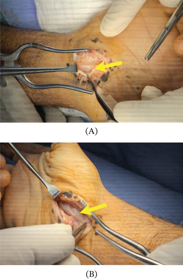 Two operative photographs, A and B, of a volar wrist exposure with a yellow arrow on a flexor-sheath ganglion between the FDP tendons