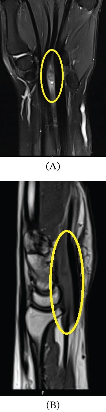 Two MRI images, A and B, with yellow ovals around an elongated flexor-sheath ganglion beside the FDP tendons at the wrist