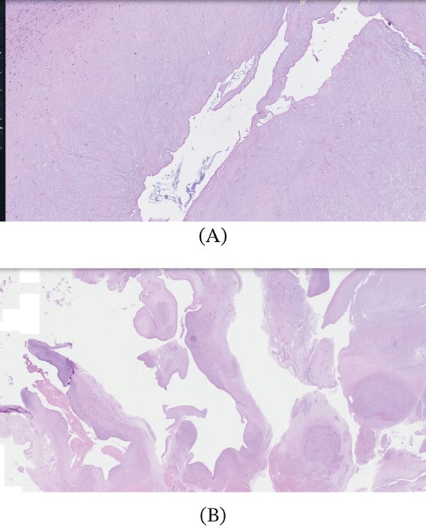 Two low-power histology sections, labelled A and B, from an excised ganglion; panel A shows a fibrous cyst wall with no epithelial lining