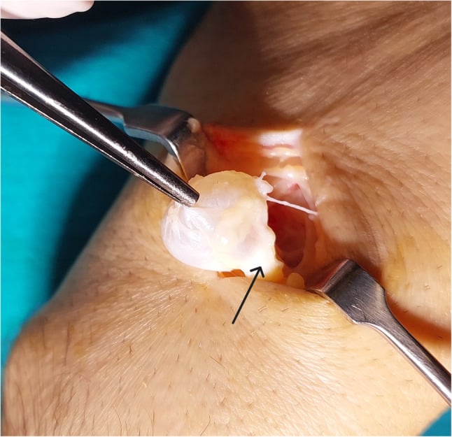 Operative photograph of a wrist ganglion lifted with forceps, a black arrow marking its stalk at the capsular origin