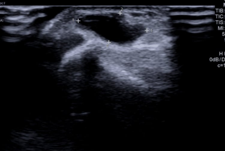 Ultrasound of a volar wrist ganglion showing a well-defined dark collection measured with calipers