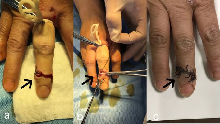 Three operative photographs, a to c, of a digital mucous cyst: the cyst with an S-shaped dorsal incision, the exposure, and the sutured wound, each marked by a black arrow