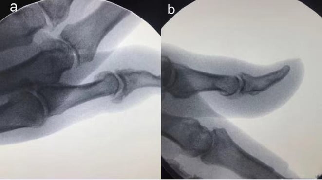 Two radiographs of a digit, a and b, before and after mucous-cyst osteophyte excision
