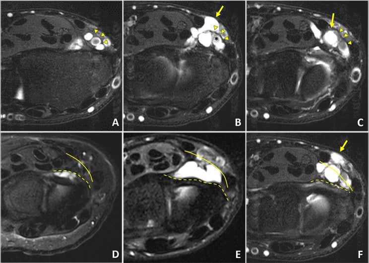 Six axial MRI panels, A to F, of a volar wrist ganglion (arrows); arrowheads and an asterisk mark the radial artery and its bifurcation in A to C, and dashed and solid lines trace fascial planes in D to F