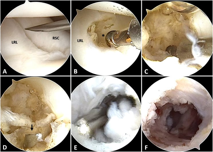 Six arthroscopic views, A to F, of volar wrist ganglion excision; a needle enters between the labelled LRL and RSC ligaments in A, and instruments open the capsule in the later panels