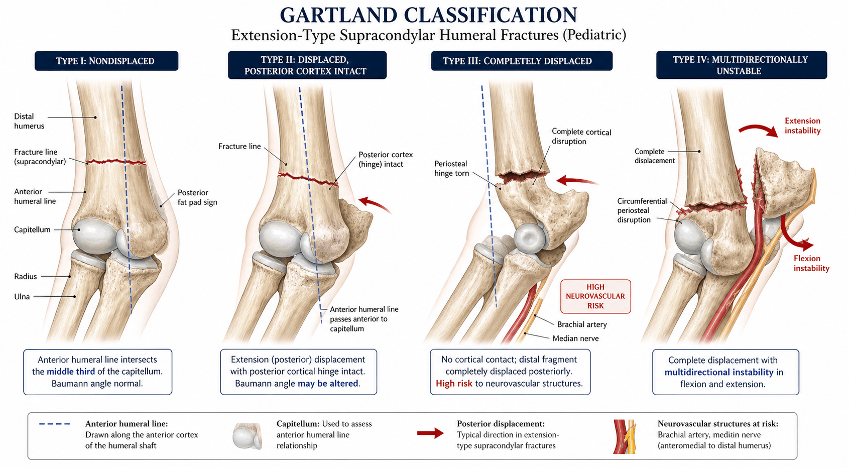 Gartland Classification of Supracondylar Humeral Fractures