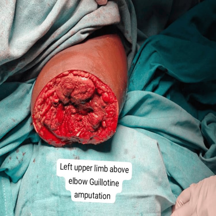 Open stump of a left above-elbow guillotine amputation with red muscle across the cut surface
