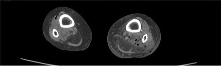Axial CT through both lower legs with a small gas locule beside the tibia in one leg and several gas bubbles in the other