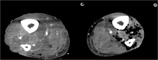 Bilateral thigh CT showing soft tissue gas