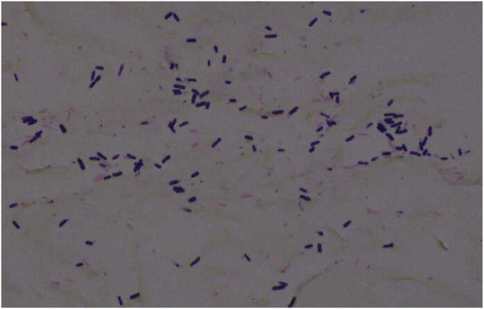 Gram stain showing numerous large, blunt-ended, boxcar-shaped Gram-positive bacilli, with no white cells in the field