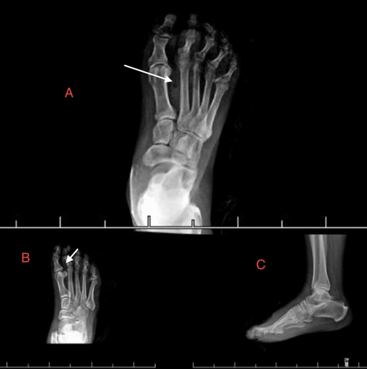 Three foot radiographs labelled A to C; arrows in A and B point to gas in the forefoot soft tissues and C is a lateral view